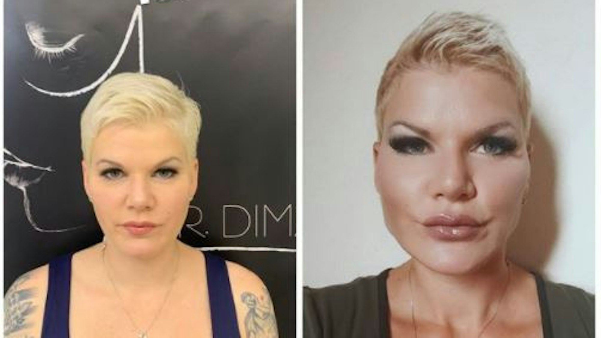 20. Juli 2021: Melanie Müller hat dieses Foto in ihrer Instagram-Story gepostet. Es zeigt einen Vorher-Nachher-Vergleich nach ihrem jüngsten Beauty-Eingriff im Gesicht.