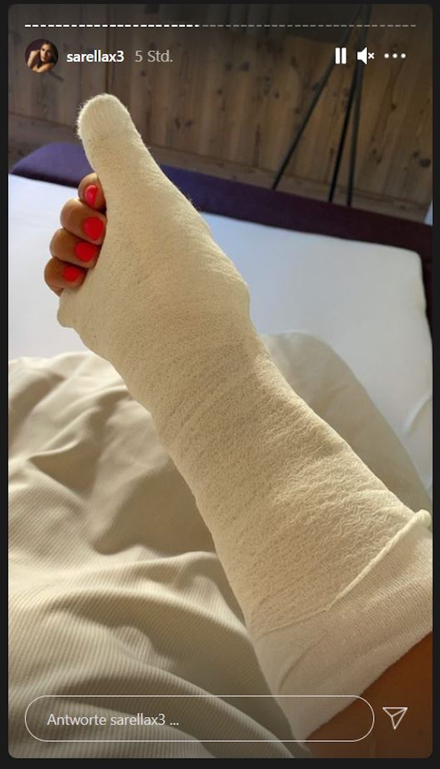 Sarah Engels hat sich im Uralub in Tirol das Kahnbein gebrochen. In ihrer Instagram-Story vom 29.7.2021 zeigt die Sängeirn ihren eingegipsten rechten Arm.