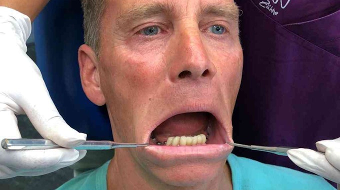 BB-Star Jürgen Milski wird in einer Zahnarztpraxis behandelt.&nbsp;