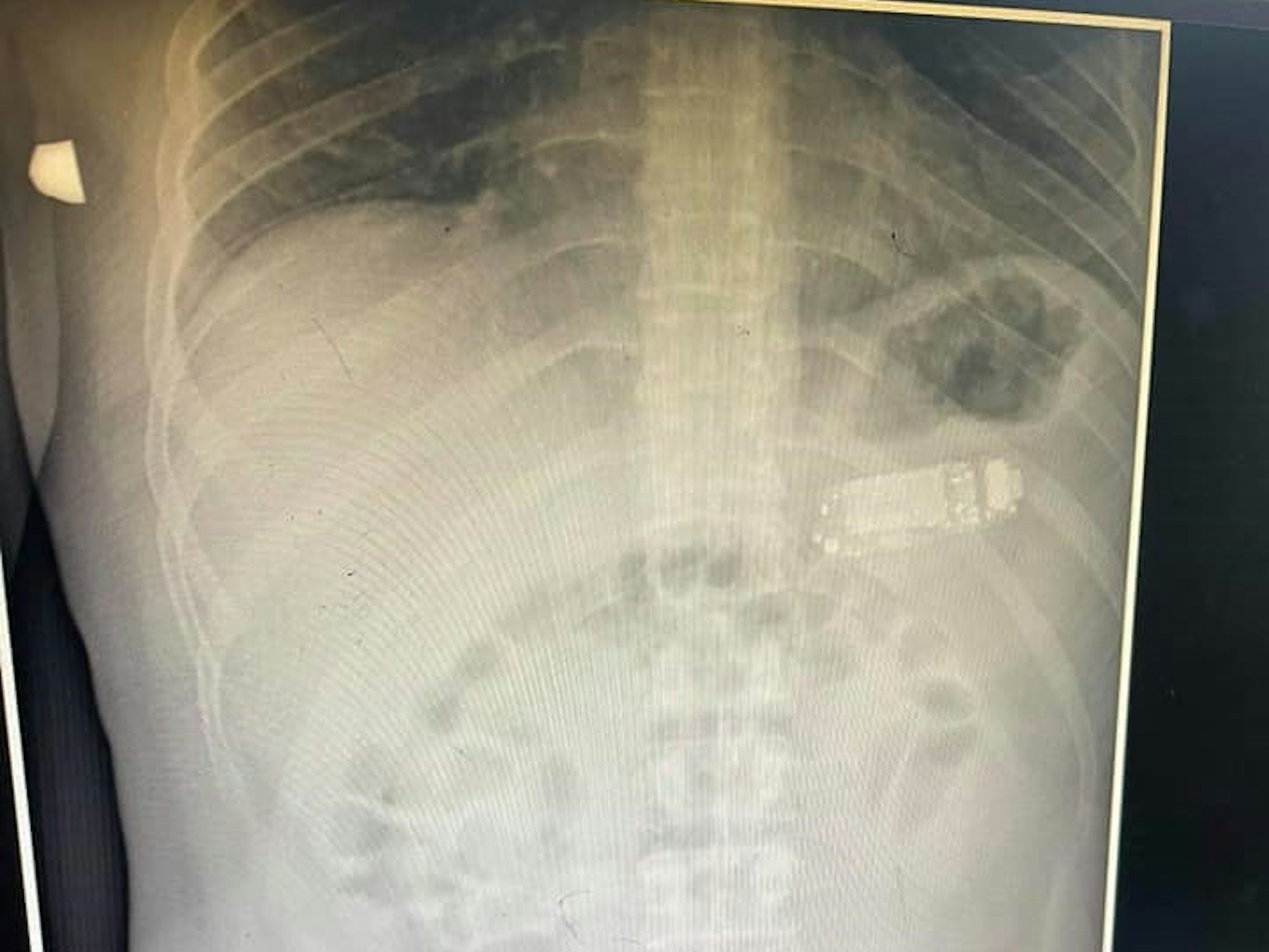 Facebook Skender Telaku am 30.8.2021 Röntgenbild von einem Patienten mit Handy im Magen.
