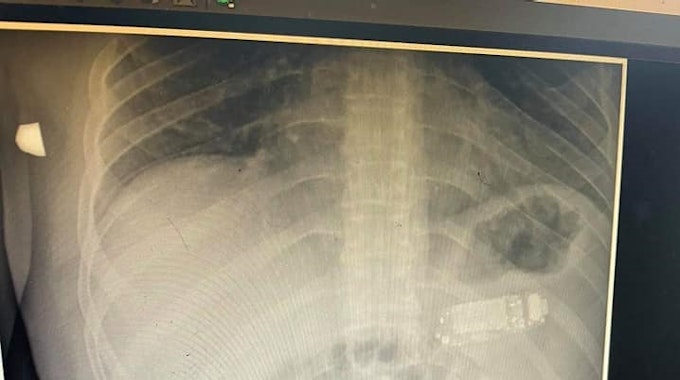 Facebook Skender Telaku am 30.8.2021 Röntgenbild von einem Patienten mit Handy im Magen.
