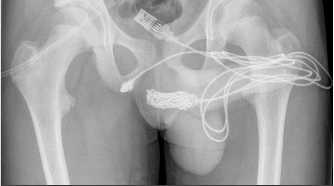 Auf dem Röntgenbild ist deutlich das verknotete USB-Kabel zu sehen, das im Körper des Jugendlichen stecken geblieben war. Der Teenager führte es bei einem fehlgeschlagenen sexuellen Experiment in seinen Penis ein.