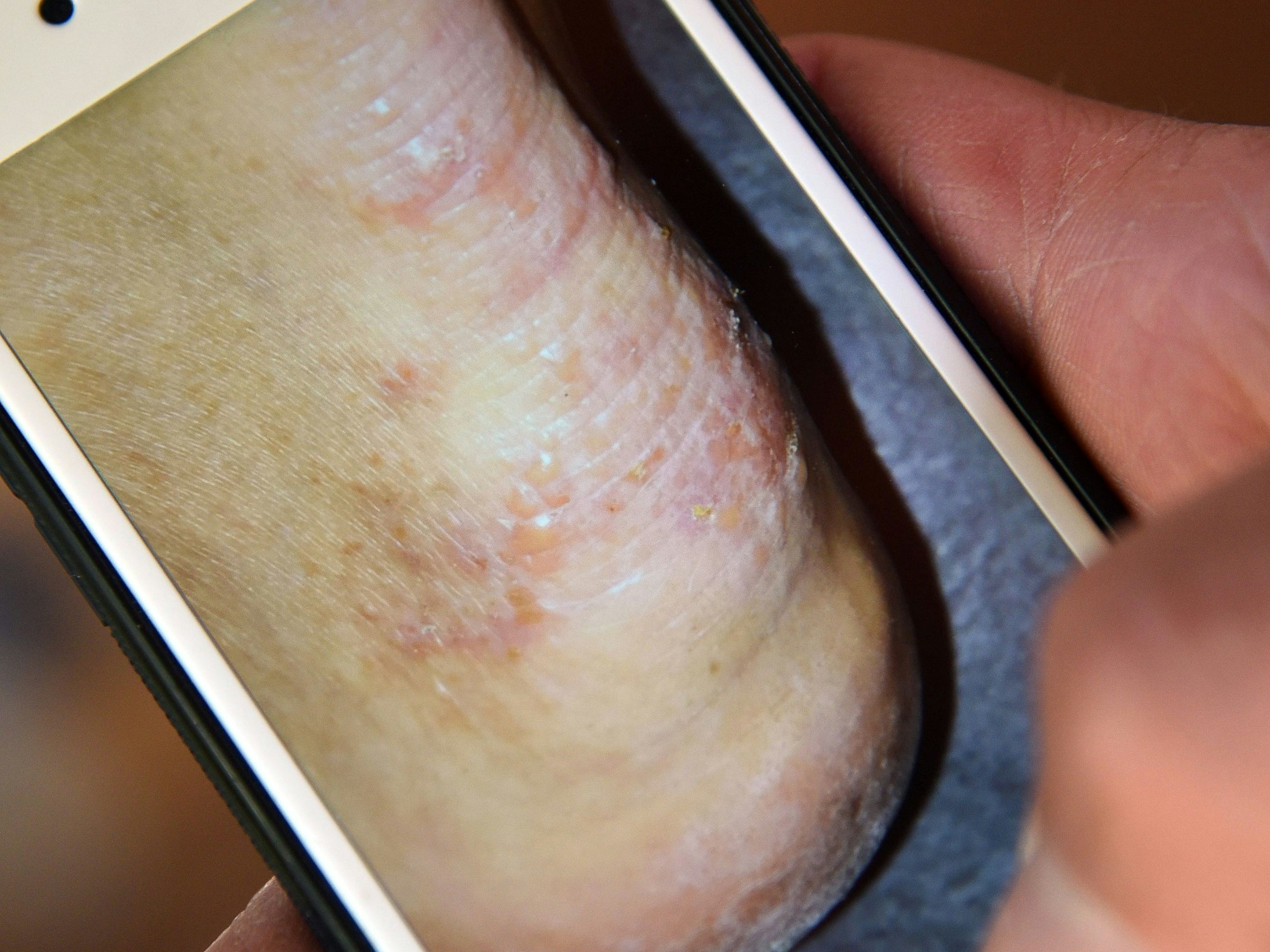 Ein Mann zeigt auf unserem Archivbild aus dem Jahr 2018 auf einem Smartphone ein Foto seines von Krätze befallenen Fußes.