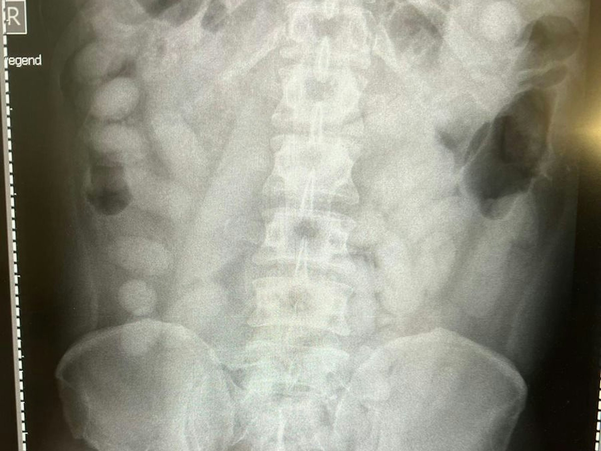 Auf dem Röntgenbild des Körperschmugglers sind ovale Päckchen zu sehen.