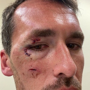 Christian Fuchs zeigt seine Verletzungen im Gesicht