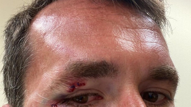 Christian Fuchs zeigt seine Verletzungen im Gesicht