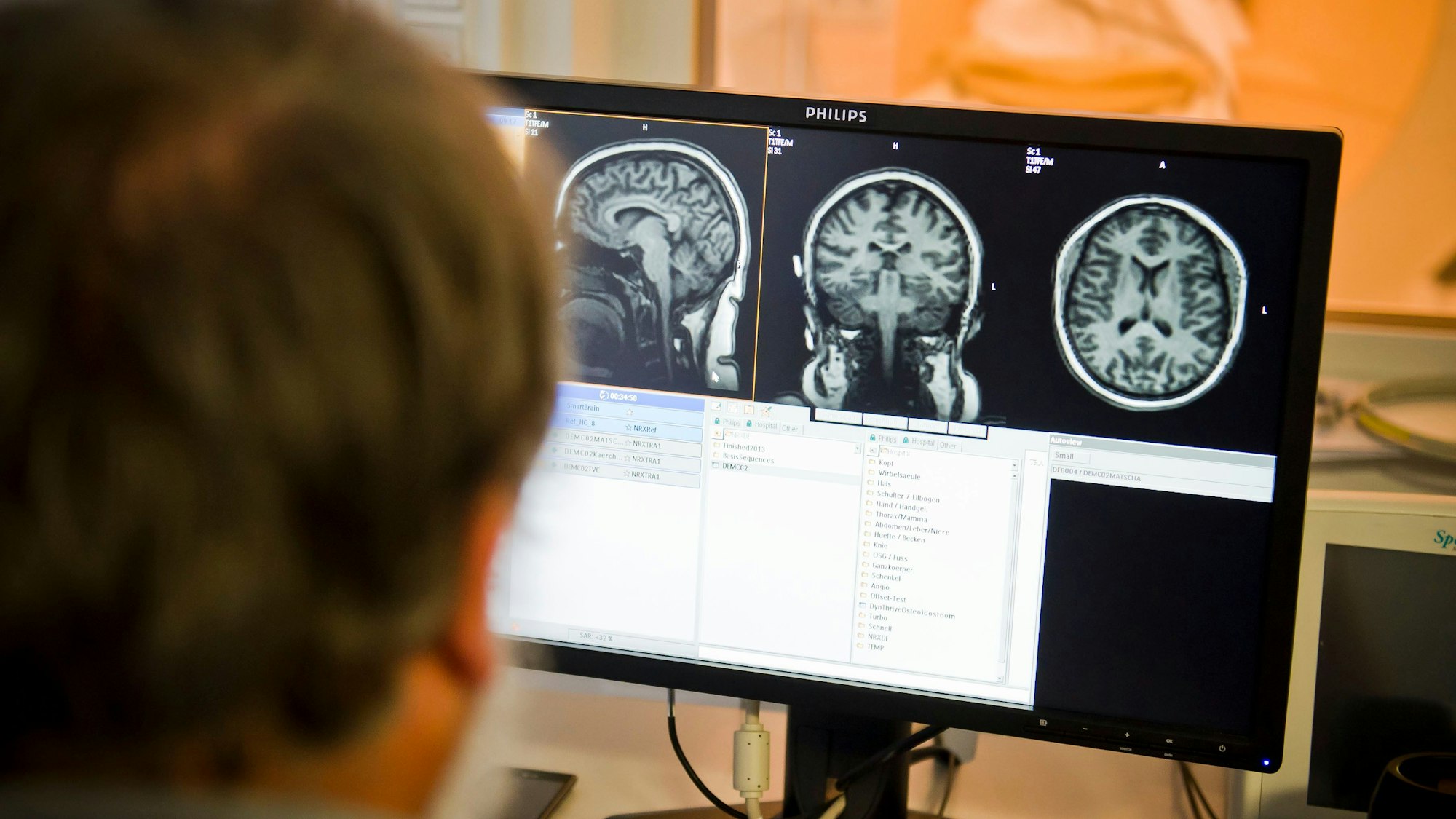 Das Foto zeigt Aufnahmen eines Gehirn aus einem Kernspintomograf.