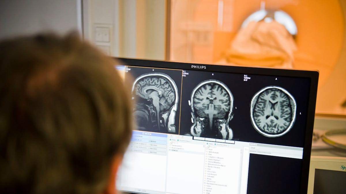 Das Foto zeigt Aufnahmen eines Gehirn aus einem Kernspintomograf.