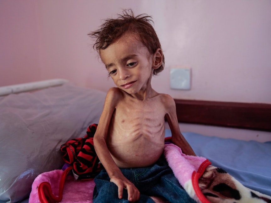 Ein unterernährter Junge sitzt auf einem Krankenhausbett im Aslam Health Center in Hadschah im Jemen im Oktober 2018