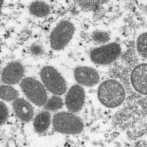 Diese elektronenmikroskopische Aufnahme aus dem Jahr 2003, die von den Centers for Disease Control and Prevention zur Verfügung gestellt wurde, zeigt reife, ovale Affenpockenviren (l) und kugelförmige unreife Virionen (r).