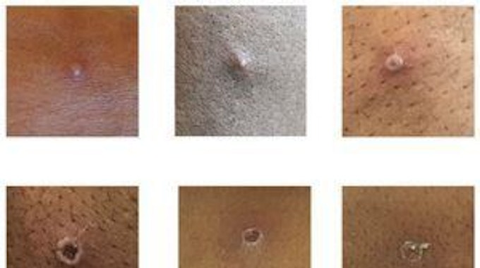 Das von der britischen Health Security Agency (UKHSA) zur Verfügung gestellte Bild zeigt Hautläsionen bei Patienten, bei denen Affenpocken nachgewiesen wurden.
