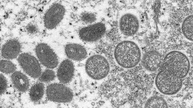 Diese elektronenmikroskopische Aufnahme aus dem Jahr 2003 zeigt reife, ovale Affenpockenviren (l) und kugelförmige unreife Virionen (r), die aus einer menschlichen Hautprobe im Zusammenhang mit dem Präriehundeausbruch von 2003 stammt.