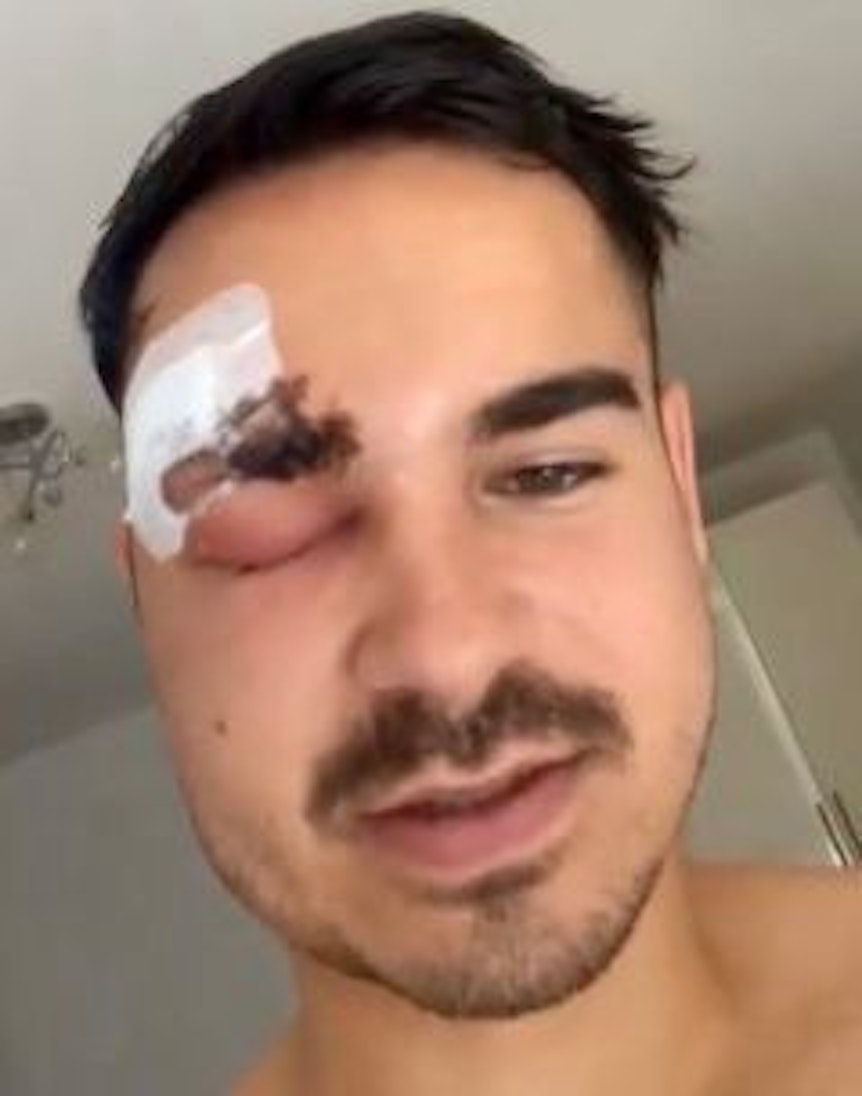 YouTuber Erne Embeli mit einer schweren Augenverletzung.