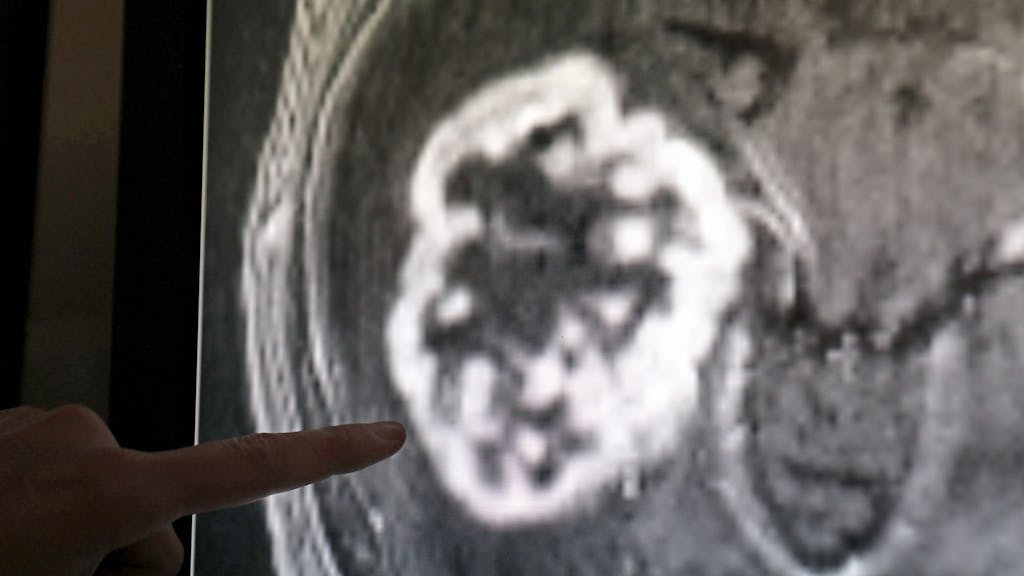 In der Diagnostik der Radiologie der Universitätsmedizin Rostock wird mithilfe der Magnetresonanztomografie ein Tumor festgestellt.