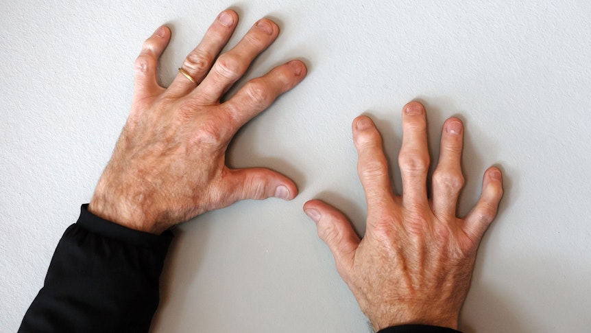 Toni Schumacher zeigt seine Hände, die Finger sind stark verformt, die Gelenke verdickt.