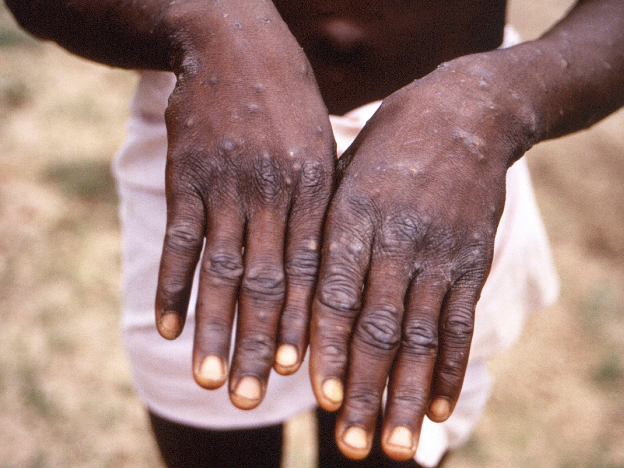 Affenpocken heißen ab sofort Mpox. Dieses Symbolbild aus dem Jahr 1997, das von der CDC während einer Untersuchung eines Ausbruchs in der Demokratischen Republik Kongo, dem früheren Zaire, zur Verfügung gestellt wurde, zeigt die Rückenflächen der Hände eines Affenpocken-Patienten, der den charakteristischen Ausschlag in der Erholungsphase zeigt.