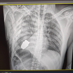 Röntgen-Foto: Eine scharfe Granate steckt in der Brust eines ukrainischen Soldaten.