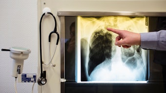 ARCHIV - 23.02.2016, Berlin: Ein Arzt zeigt einen Tuberkulose-Fall anhand eines Röntgenbildes in seinem Büro im Tuberkulosezentrum.
