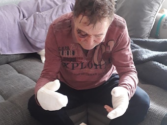 Josef G., Opfer einer Messer-Attacke in Köln-Weidenpesch, zeigt seine Verletzungen.