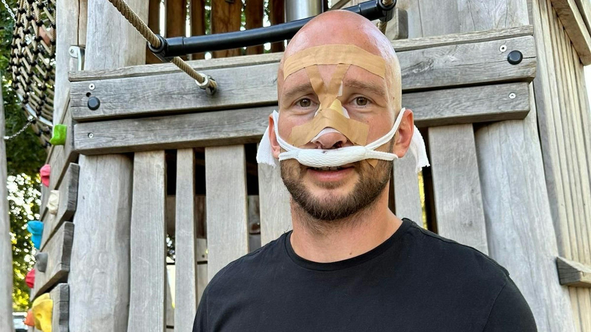 Toni Leistner nach erfolgreicher OP an seiner gebrochenen Nase.