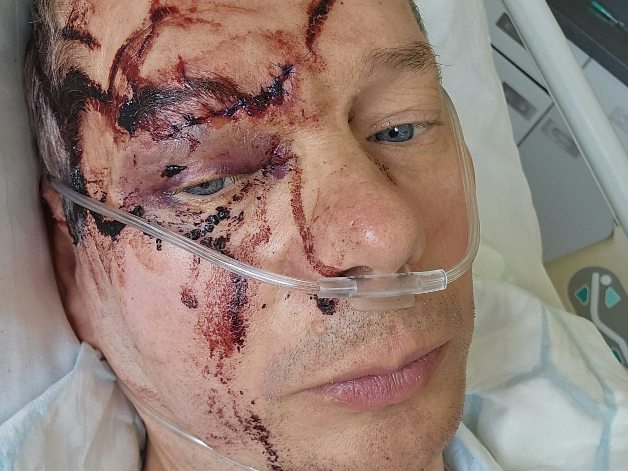 Verletzter Mann mit Blutflecken im Gesicht schaut für ein Selfie im Krankenhaus in die Kamera.