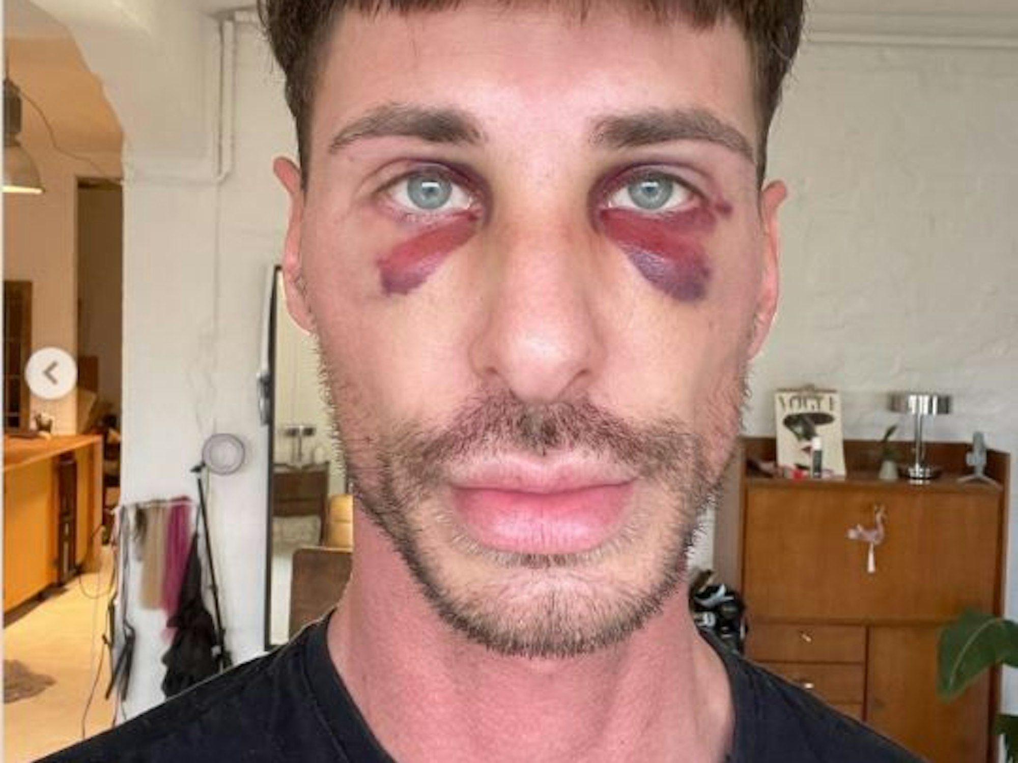 Pitzi Müller zeigt auf seinem Instagram-Account sein verletztes Gesicht, nachdem er angegriffen wurde.