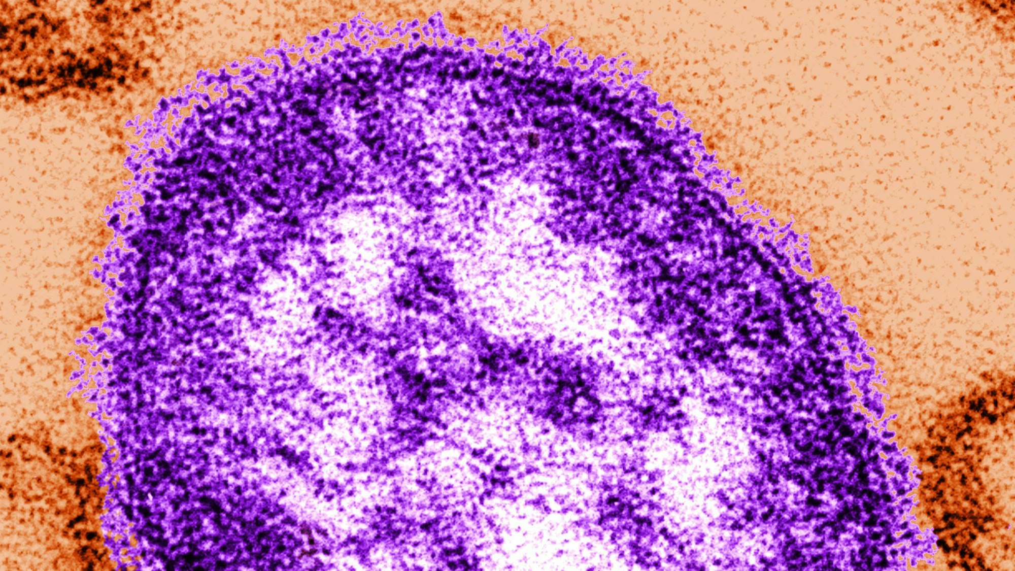 Eine undatierte Abbildung, die mithilfe eines Transmissionselektronenmikroskops gemacht wurde, zeigt Teile eines Masernvirus. (Archivbild)