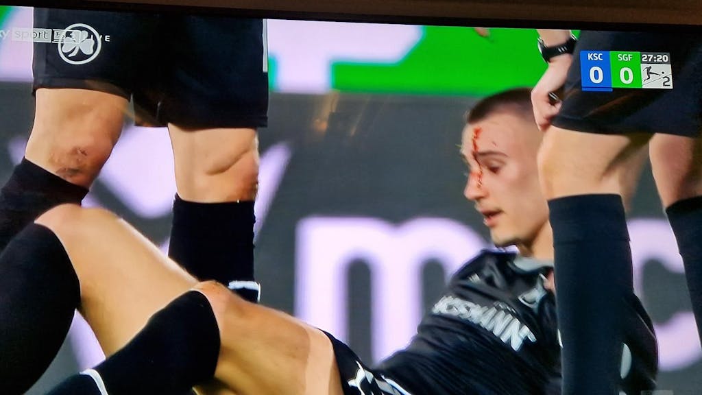 Tim Lemperle blutet nach einem Zweikampf beim Spiel von Greuther Fürth in Karlsruhe im Gesicht.