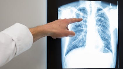 Ein Arzt zeigt im Vivantes Klinikum Neukölln auf das Röntgenbild einer Lunge.