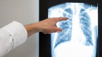 Ein Arzt zeigt im Vivantes Klinikum Neukölln auf das Röntgenbild einer Lunge.