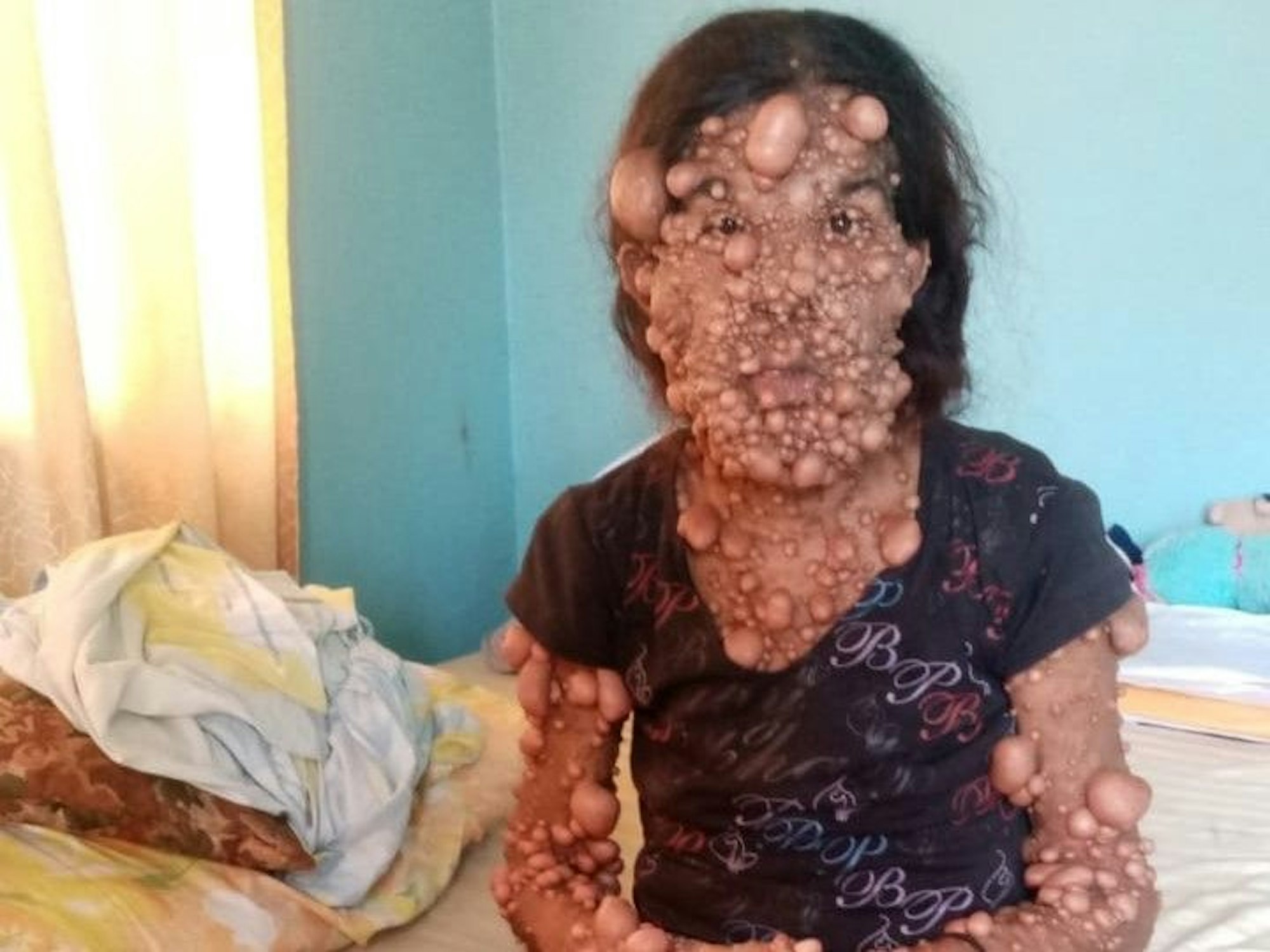 Charmaine Sahadeo (42) leidet an einer seltenen Krankheit namens Neurofibromatose Typ 1. Lebensbedrohliche Tumore wachsen überall am Körper. Das Foto hat sie am 20. Juni 2022 von sich auf Facebook gepostet.