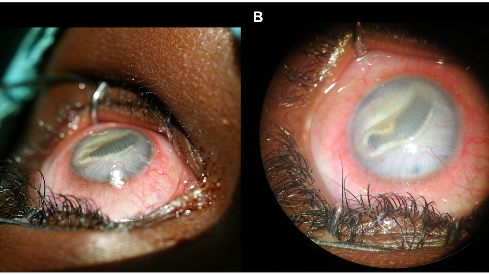 Das Foto zeigt einen Fall aus dem Jahr 2014, bei dem der Parasit im linken Auges eines elfjährigen Mädchens aus dem Kongo zu sehen ist. Es stammt aus der Fachzeitschrift „PLOS Neglected Tropical Diseases“.