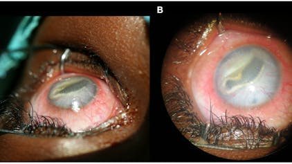 Das Foto zeigt einen Fall aus dem Jahr 2014, bei dem der Parasit im linken Auges eines elfjährigen Mädchens aus dem Kongo zu sehen ist. Es stammt aus der Fachzeitschrift „PLOS Neglected Tropical Diseases“.