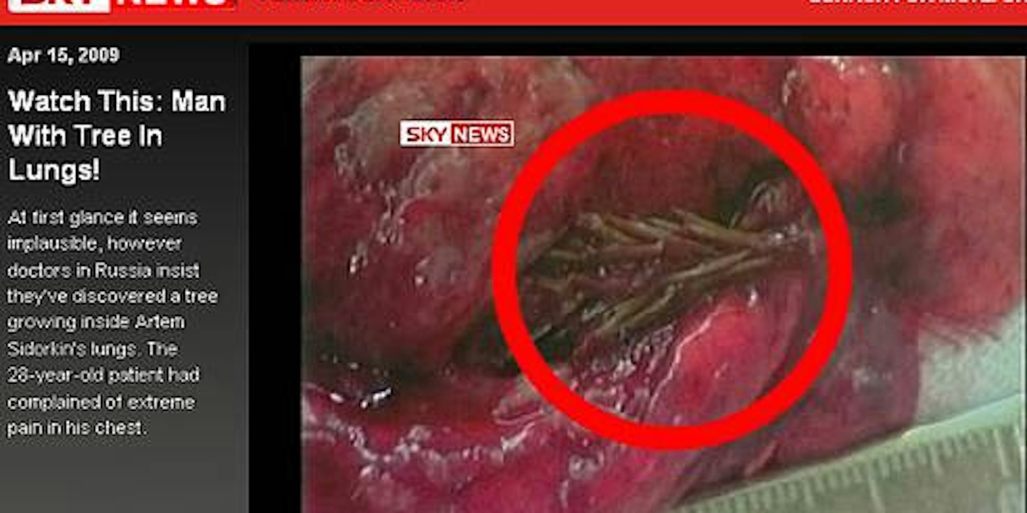 Sky News zeigt ein Video: Diese kleine Tanne hatte es sich in der Lunge des Patienten gemütlich gemacht.