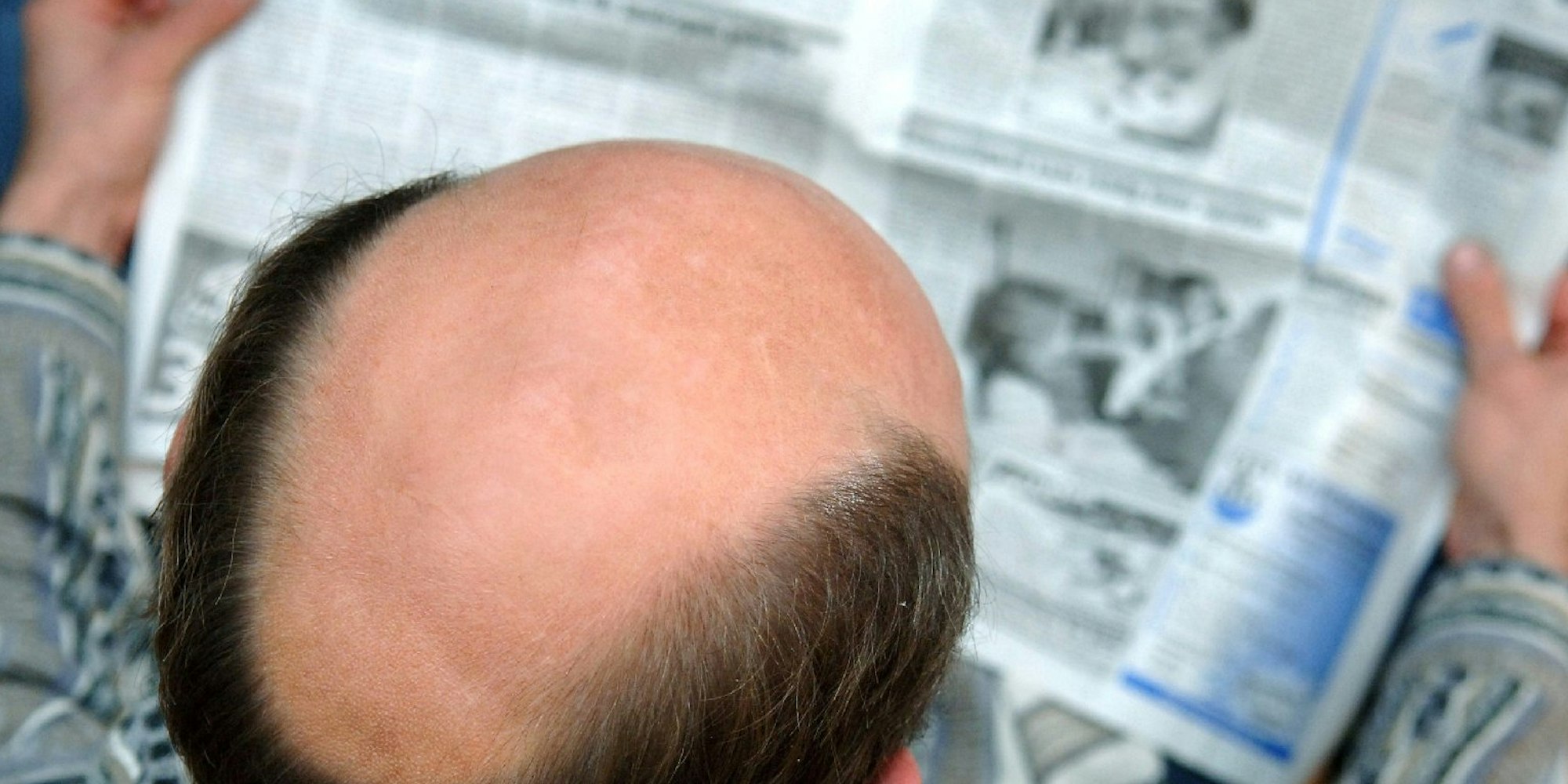 Erblich bedingter Haarausfall lässt sich bislang nicht aufhalten. Forscher haben nun erstmals auf kahler menschlicher Haut im Labor Haare sprießen lassen.