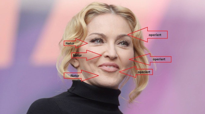 Aufspritzen, glatt bügeln oder direkt unters Messer: Madonna lässt ihr Gesicht regelmäßig vom Arzt bearbeiten. Nur die Falten um Augen, Nase und am Kinn lässt sie so.