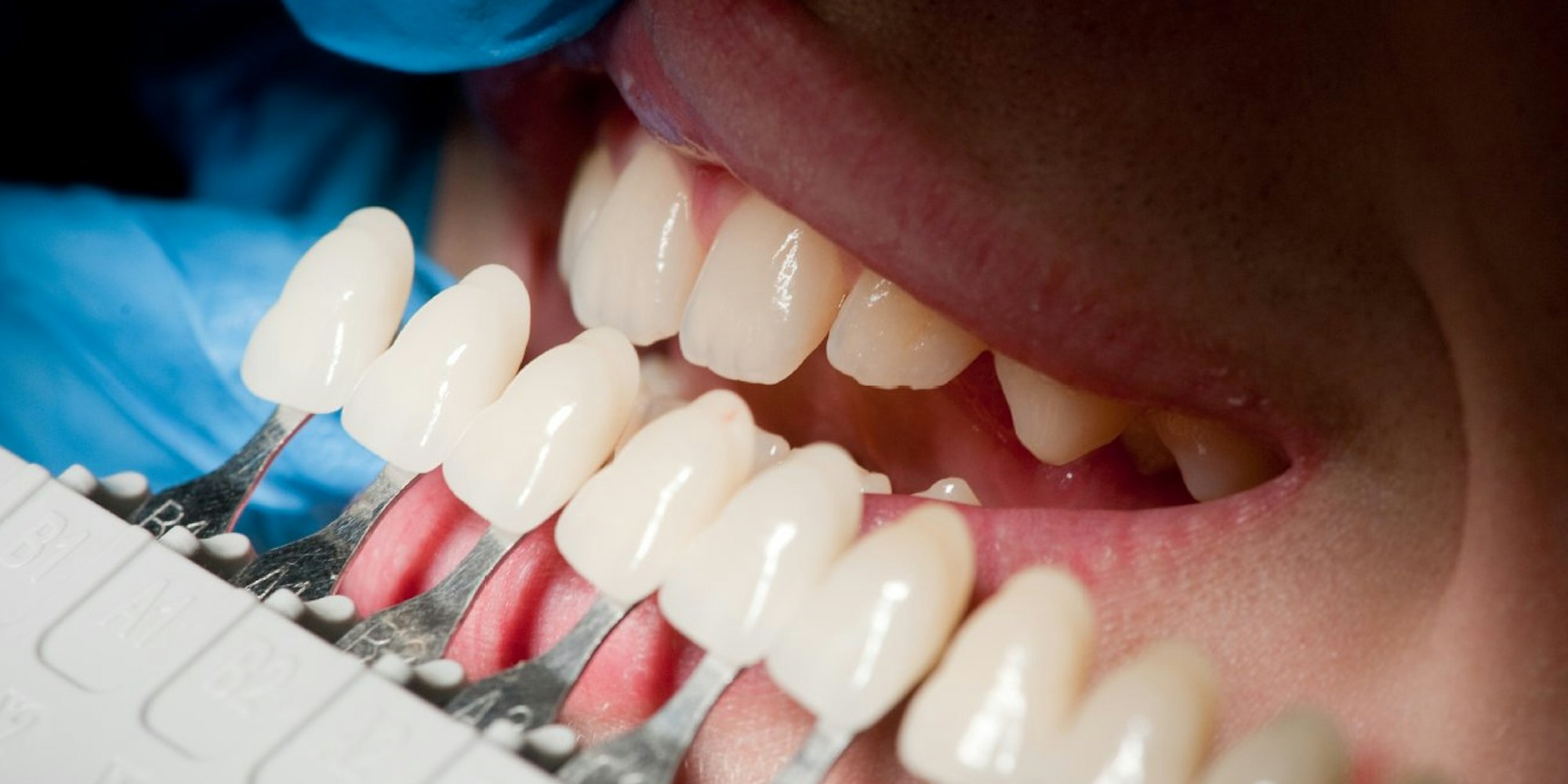 Was die Zahnpasta nicht schafft, kann ein Bleaching beim Zahnarzt wettmachen - mit Hilfe von Wasserstoffperoxid können die Zähne bis zu drei Farbstufen heller werden.