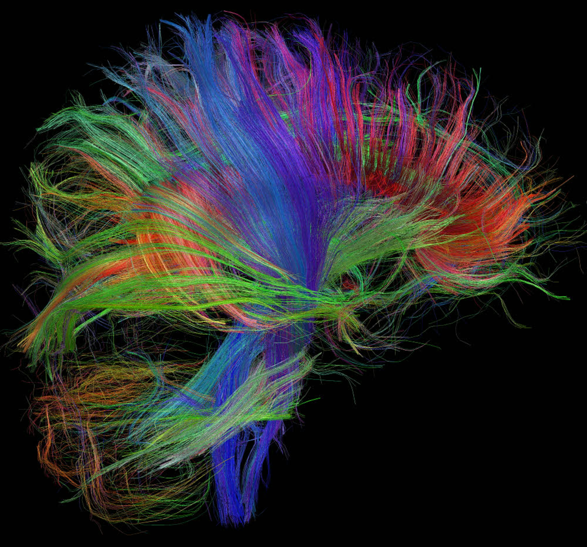 Mit einem Traktographiebild wird der Verlauf größerer Nervenfaserbündel im Gehirn sichtbar gemacht.