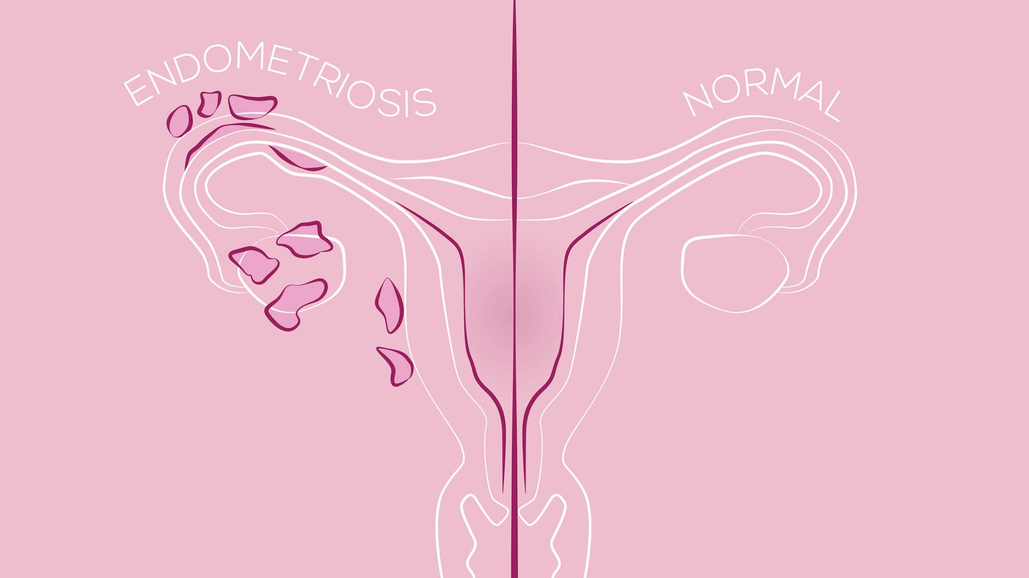 Eine Illustration von Endometriose im Vergleich zu einer gesunden Gebärmutter.