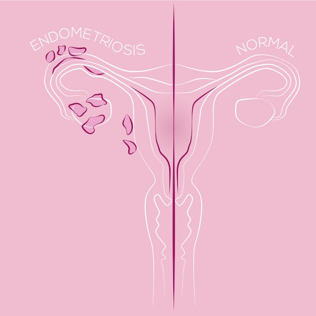 Eine Illustration von Endometriose im Vergleich zu einer gesunden Gebärmutter.