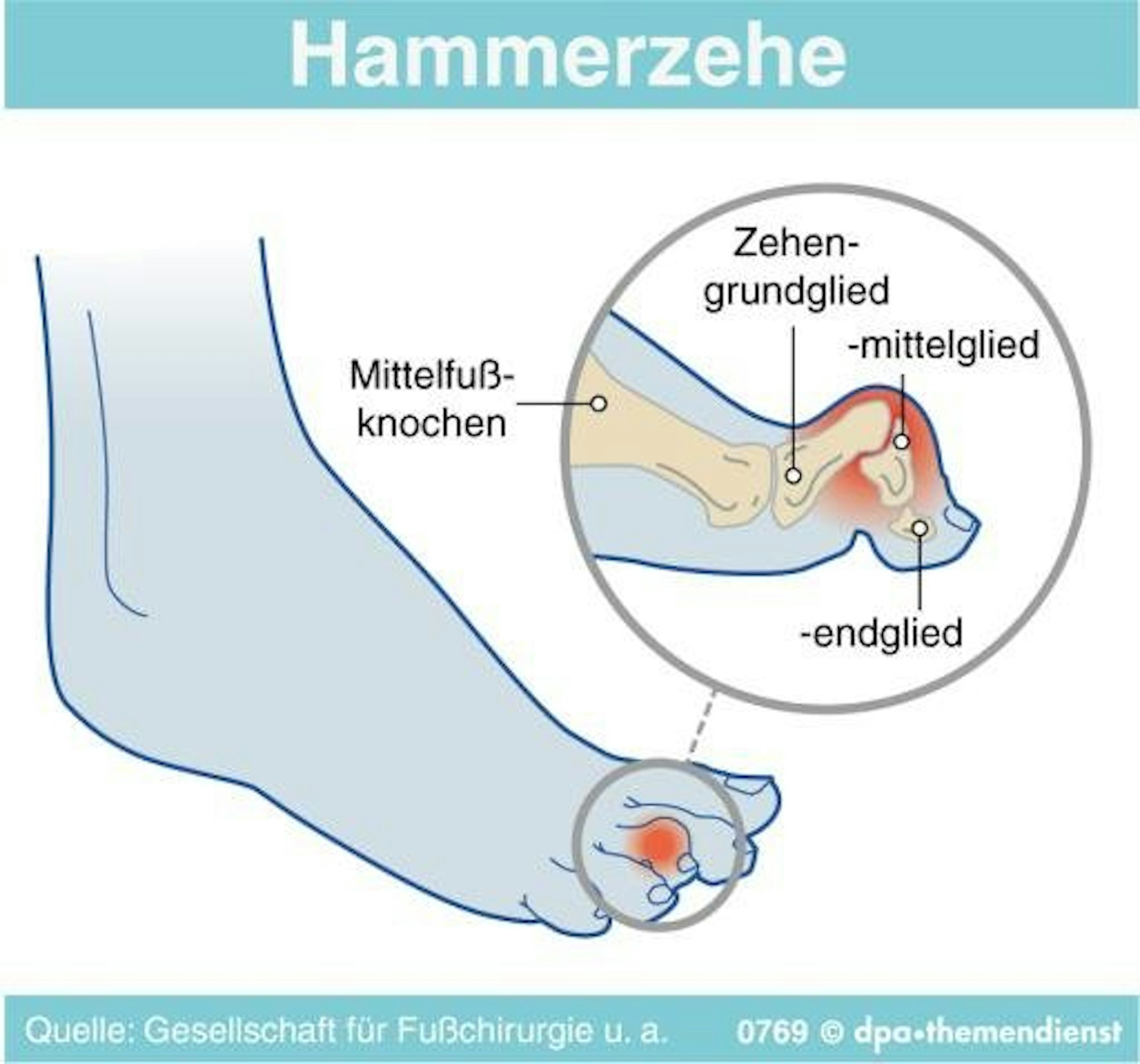 Hammerzehen2