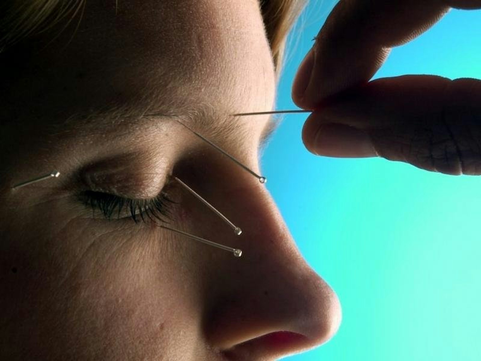 Akupunktur Es gibt inzwischen Untersuchungen, die der Akupunktur bei Migräne eine gewisse Wirksamkeit bescheinigen. Häufigkeit und Schwere der Attacken können durch das Nadelsetzen günstig beeinflusst werden.