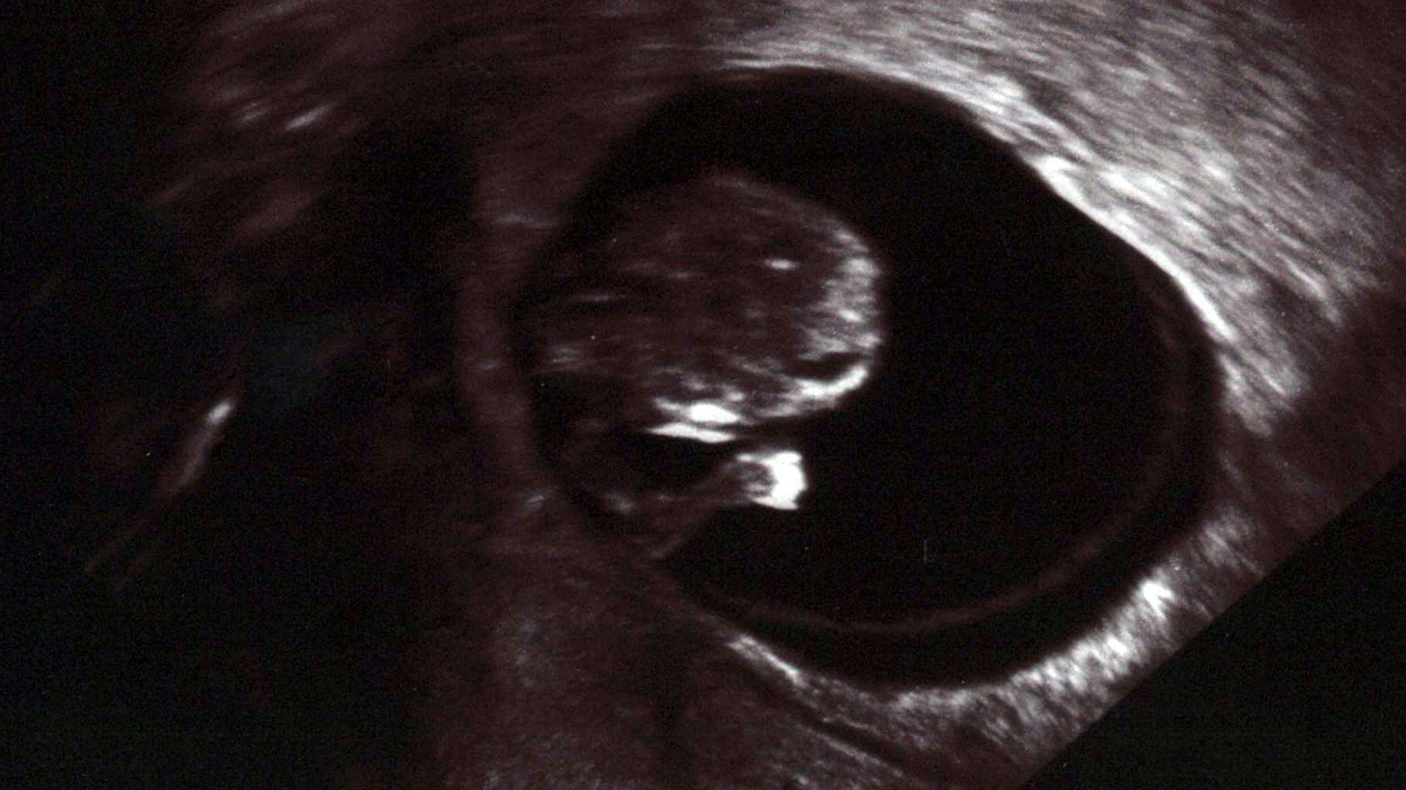 Schon in der 10. Woche ist das Ungeborene deutlich zu erkennen und man kann seinen Herzschlag auf dem Ultraschallgerät sehen.