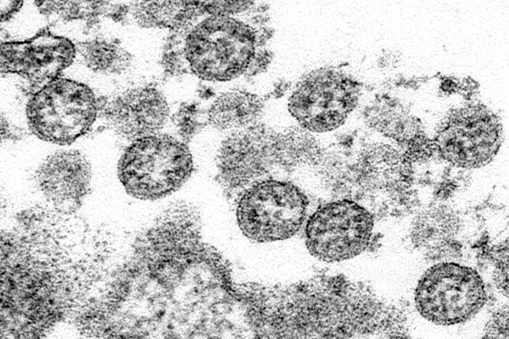 Dieses von den U.S. Centers for Disease Control and Prevention zur Verfügung gestellte Elektronenmikroskop aus dem Jahr 2020 zeigt die kugelförmigen Coronavirus-Partikel aus dem ersten US-Fall von COVID-19.