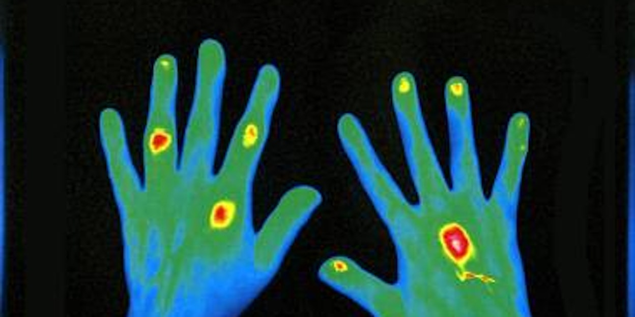 Mit einem Rheumascan lassden sich rheumatische Erkrankungen ohne Strahlenbelastung bildlich darstellen. Bild: Volberg