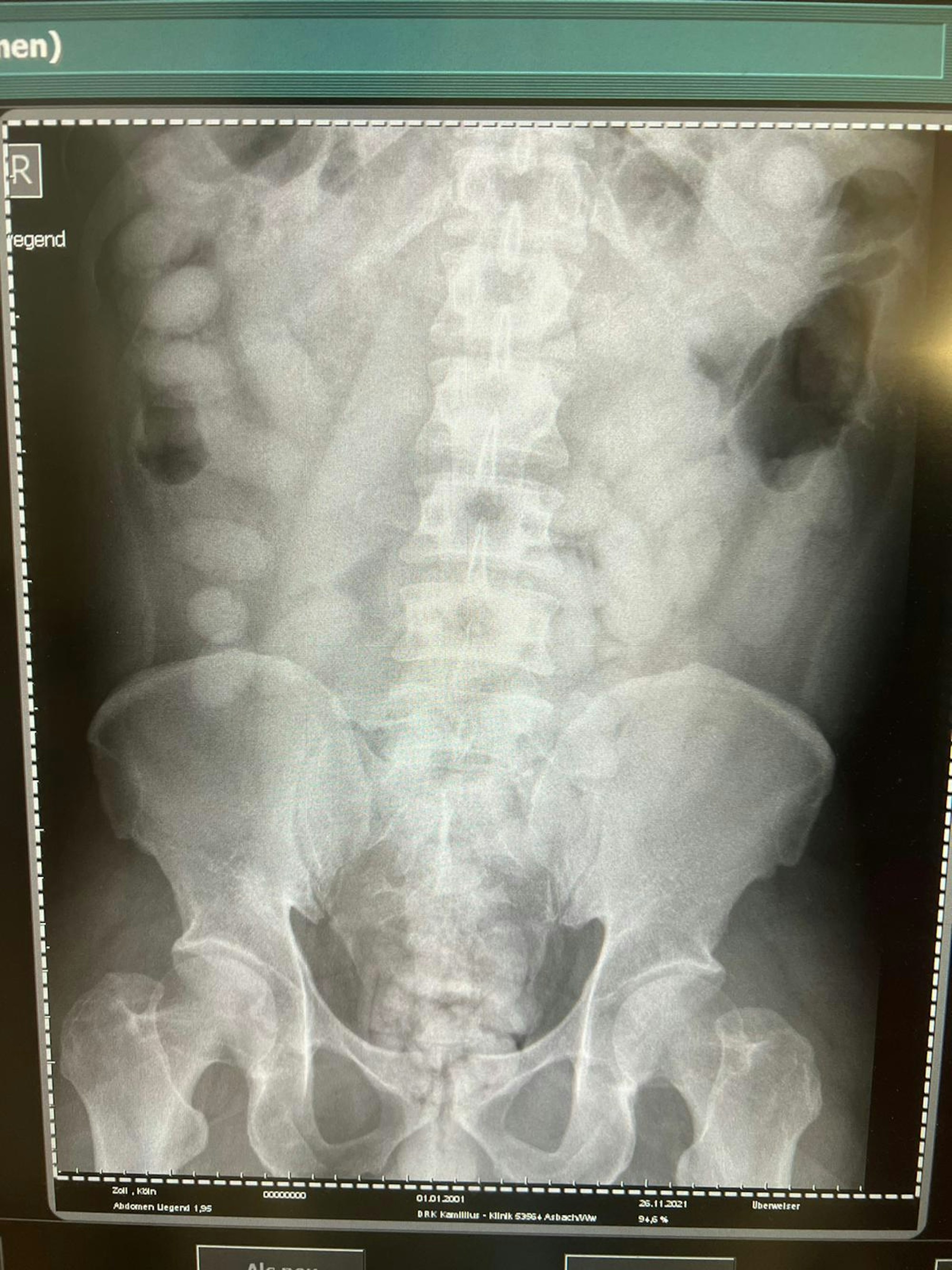 Auf dem Röntgenbild ganz links sind kleine, ovale Bodypacks mit Rauschgift zu erkennen