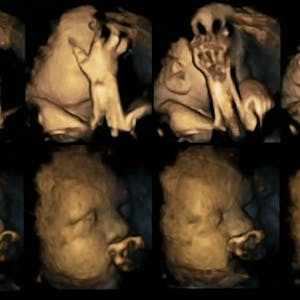Stress im Uterus: Föten von Raucherinnen (oben im Bild) bewegen häufiger das Gesicht und berühren sich öfter als Ungeborene von Nichtraucherinnen (unten).