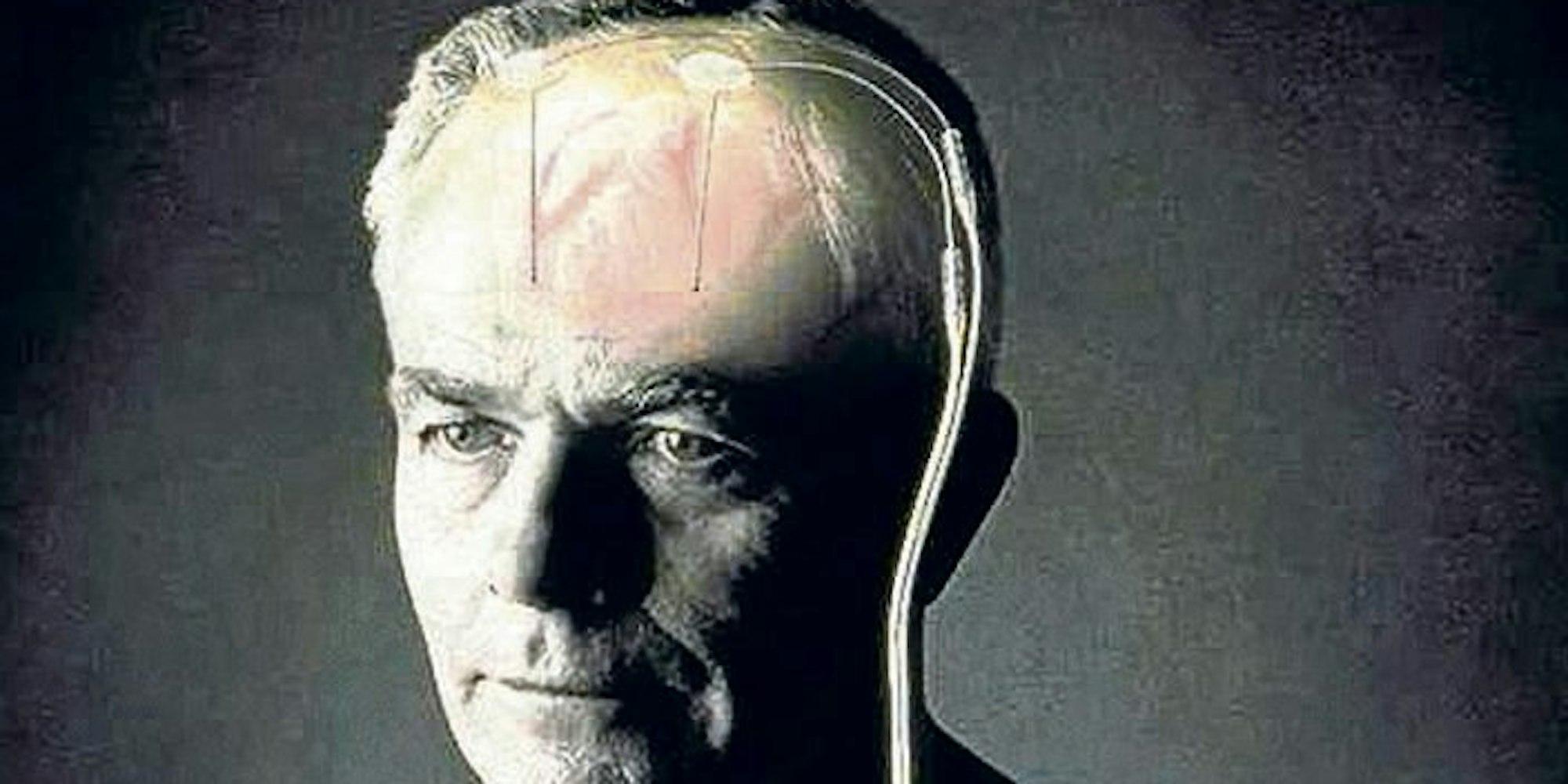 Elektroden im Hirn, Schrittmacher unter dem Schlüsselbein