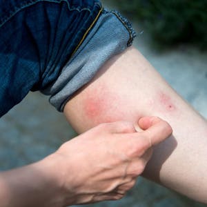Bein mit roten Mückenstichen