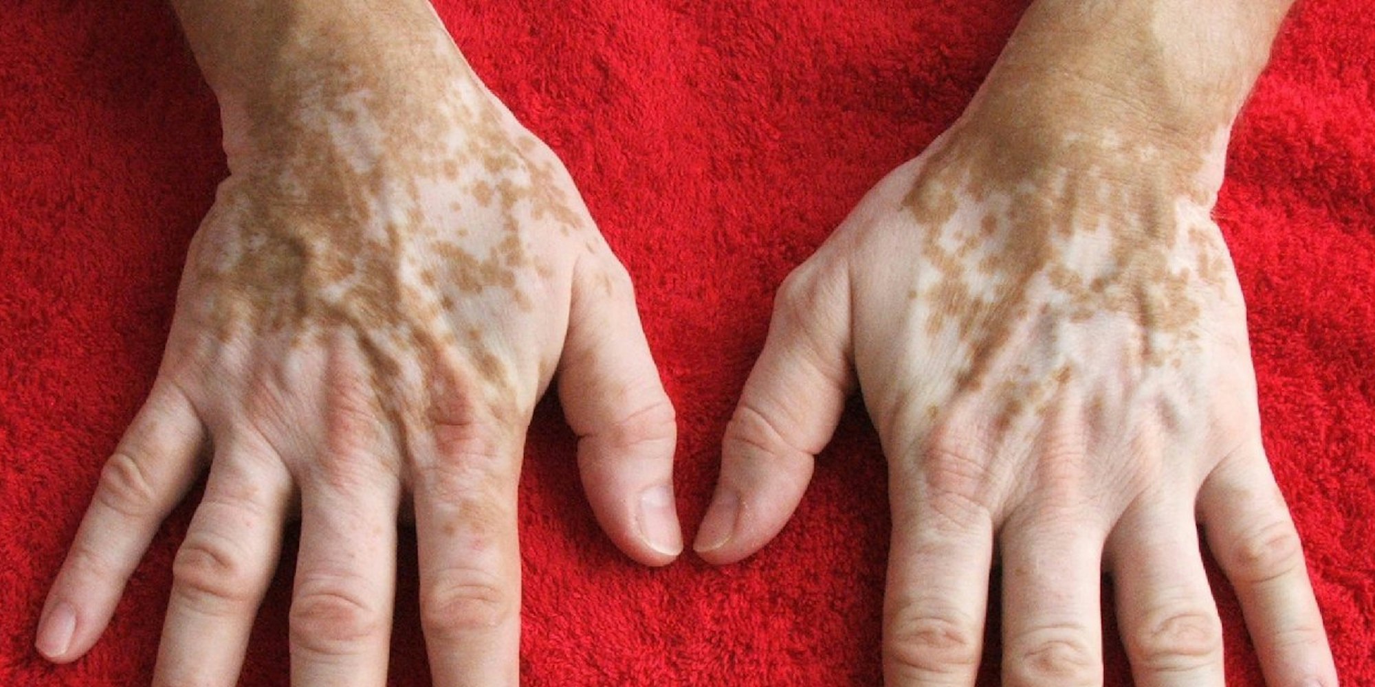 Weiße Flecken sind die einzigen Anzeichen von Vitiligo - andere Symptome gibt es nicht.